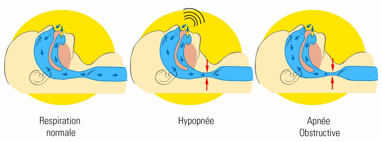 Apnées Centrales Du Sommeil Causes – KJKDL